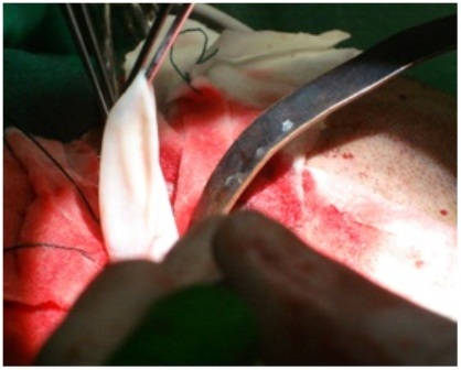 Figure-8: Excision of a hydatid cyst